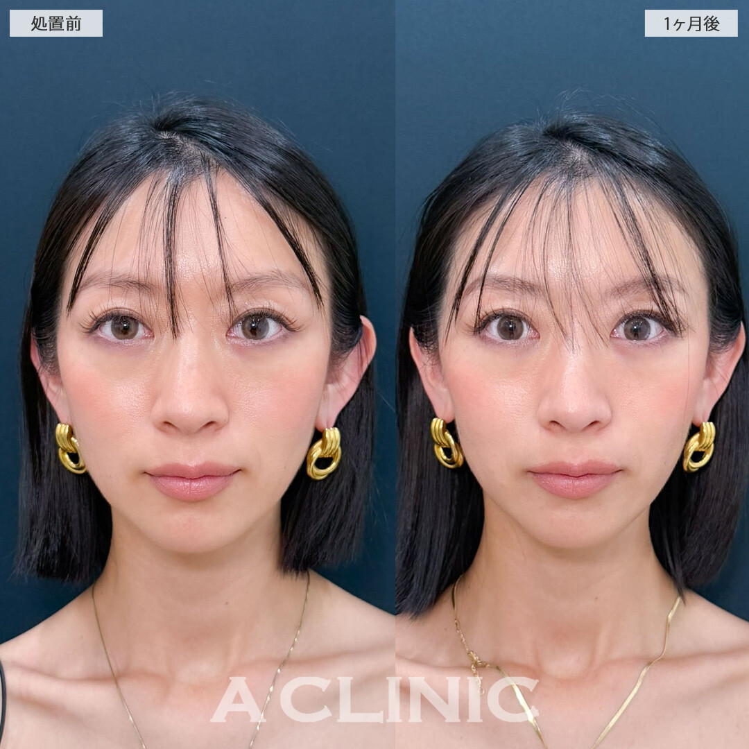 Aスレッドで輪郭を整えてさらに美しく！こちら処置前と1ヶ月後の症例です(30代女性)