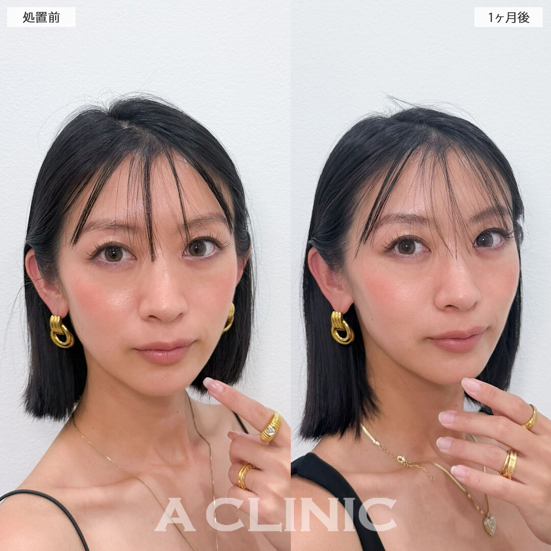 Aスレッドで輪郭を整えてさらに美しく！こちら処置前と1ヶ月後の症例です(30代女性)