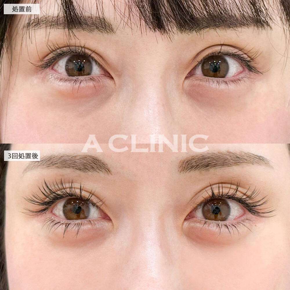 美肌サーモンスレッドなら小じわもクマも改善してくれます！こちら処置前と3回処置後の症例です(30代女性)