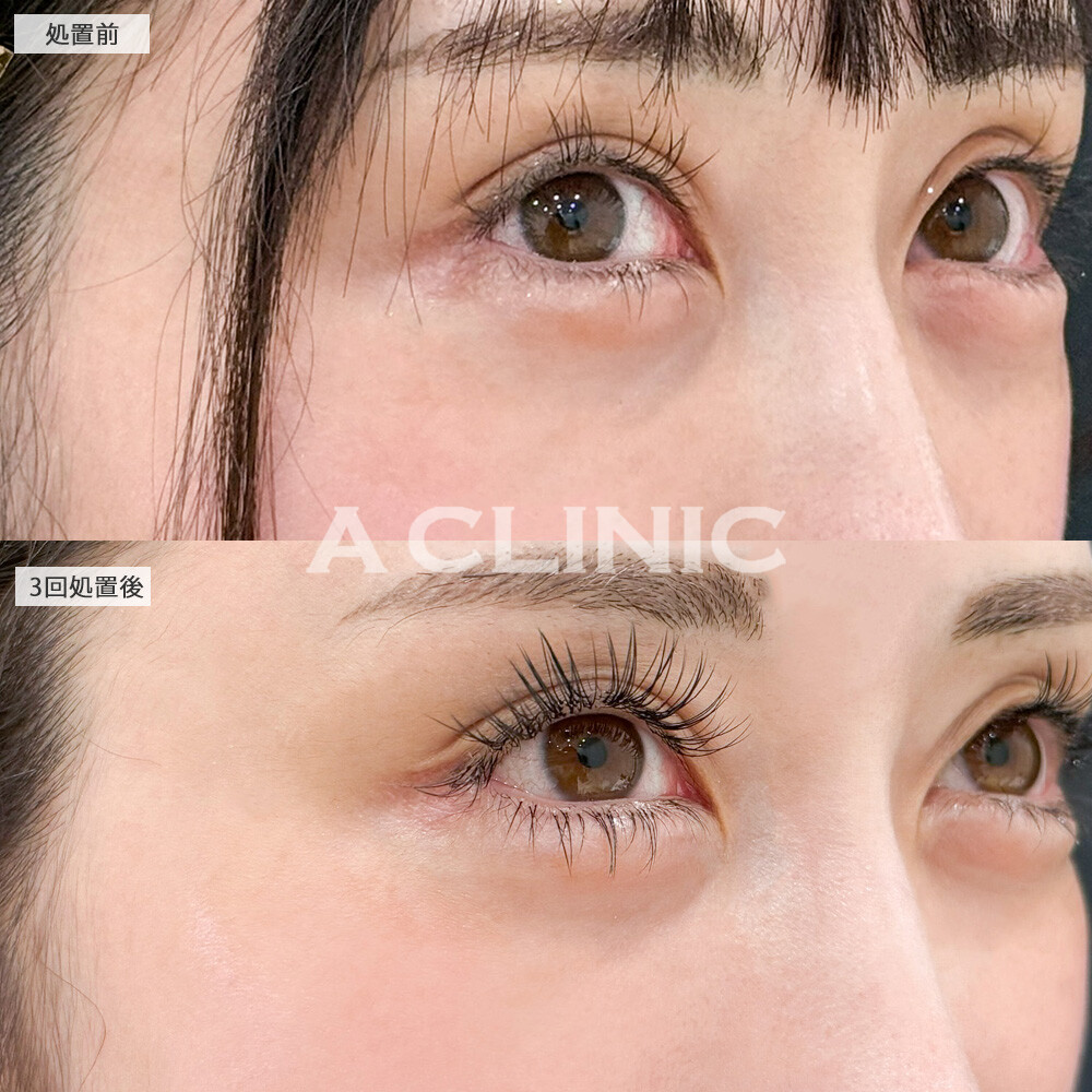 美肌サーモンスレッドなら小じわもクマも改善してくれます！こちら処置前と3回処置後の症例です(30代女性)