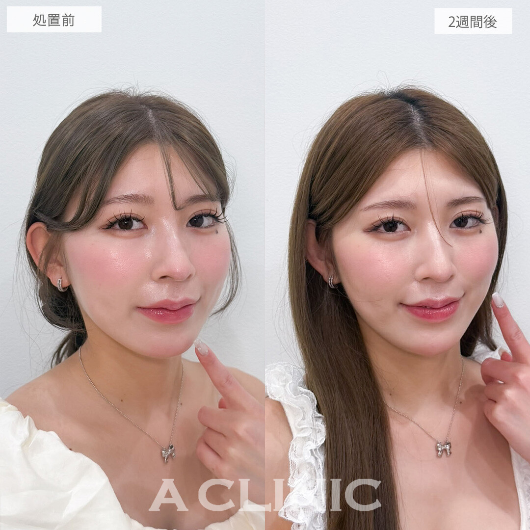 ヒアルロン酸カスタマイズメニューは2週間で自然な仕上がりに！こちら処置前と2週間後の症例です(20代女性)