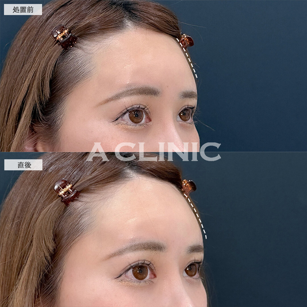 ヒアルロン酸カスタマイズメニューでしわや骨格の凹凸をなめらかにして若返り！こちら処置前と直後の症例です(30代女性)