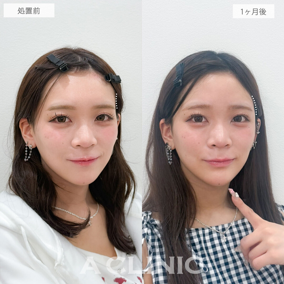 ヒアルロン酸カスタマイズメニューで凹み無くして写真写りも良くなりました！こちら処置前と1ヶ月後の症例です(20代女性)