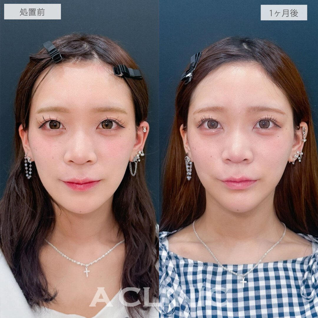 ヒアルロン酸カスタマイズメニューで凹み無くして写真写りも良くなりました！こちら処置前と1ヶ月後の症例です(20代女性)