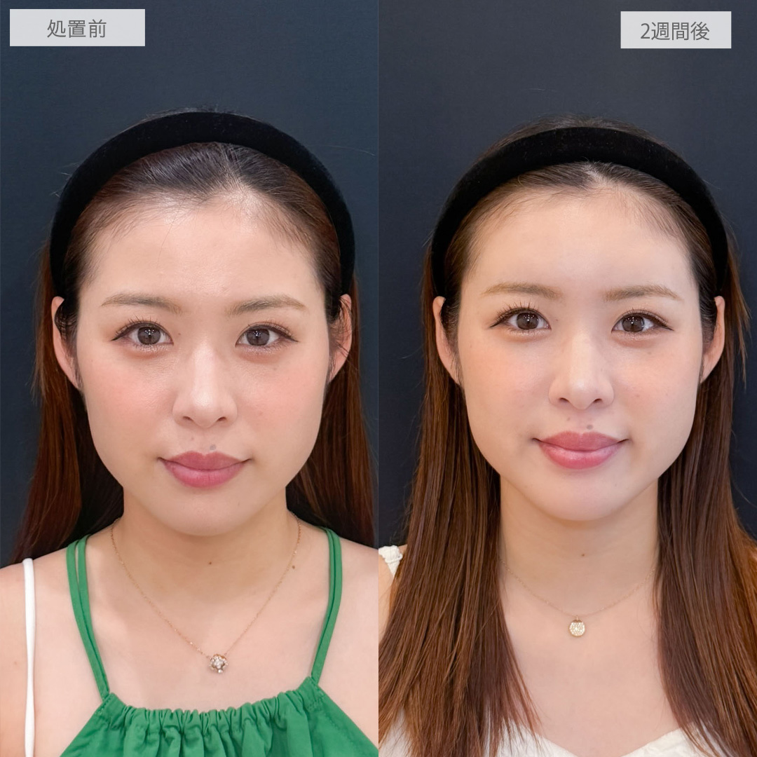 ヒアルロン酸カスタマイズメニューは2週間経過でこんなにナチュラルな仕上がりになります！こちら処置前と2週間後の症例です(20代女性)