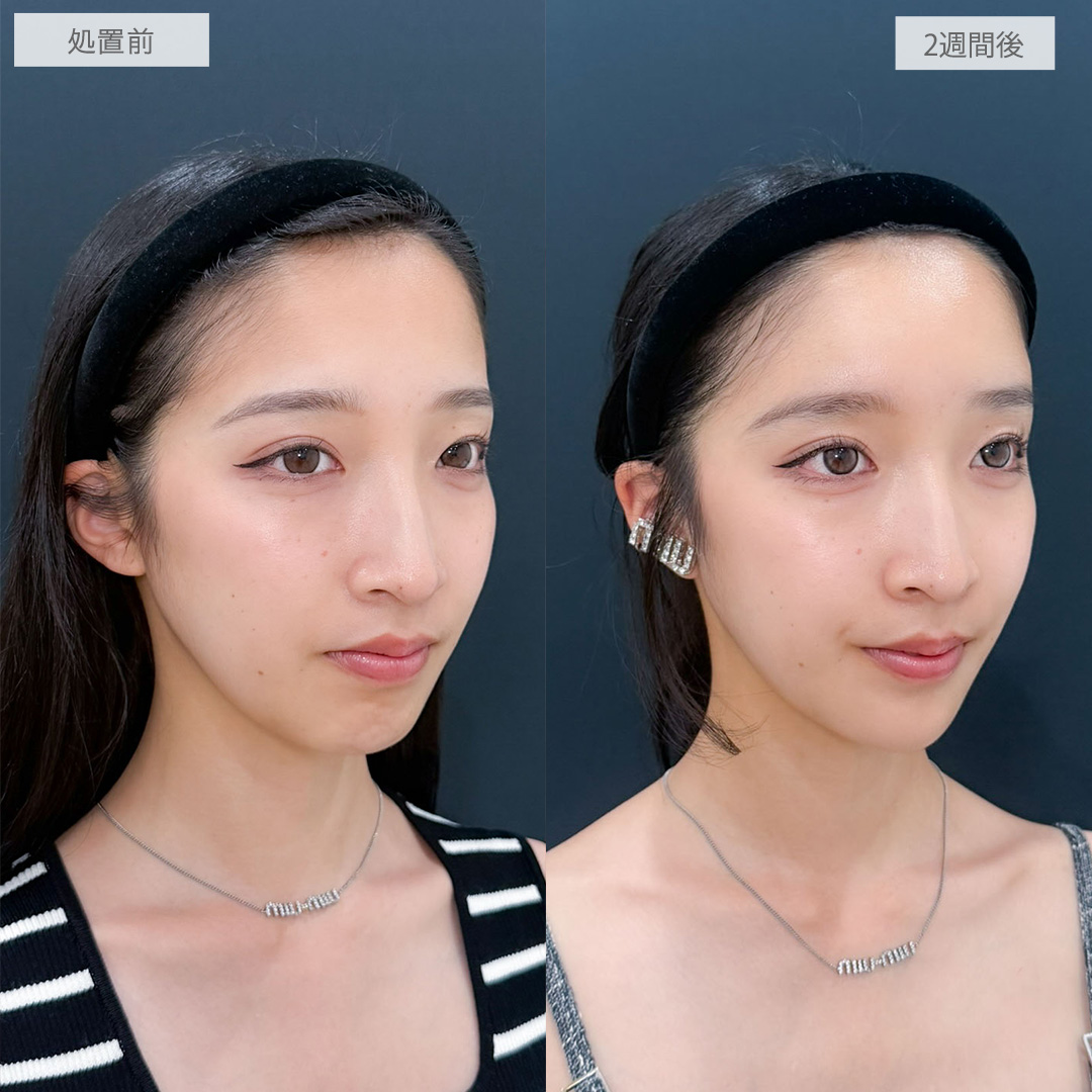 ヒアルロン酸カスタマイズメニューは注入だけで顔の立体感を作れます！こちら処置前と2週間後の症例です(20代女性)