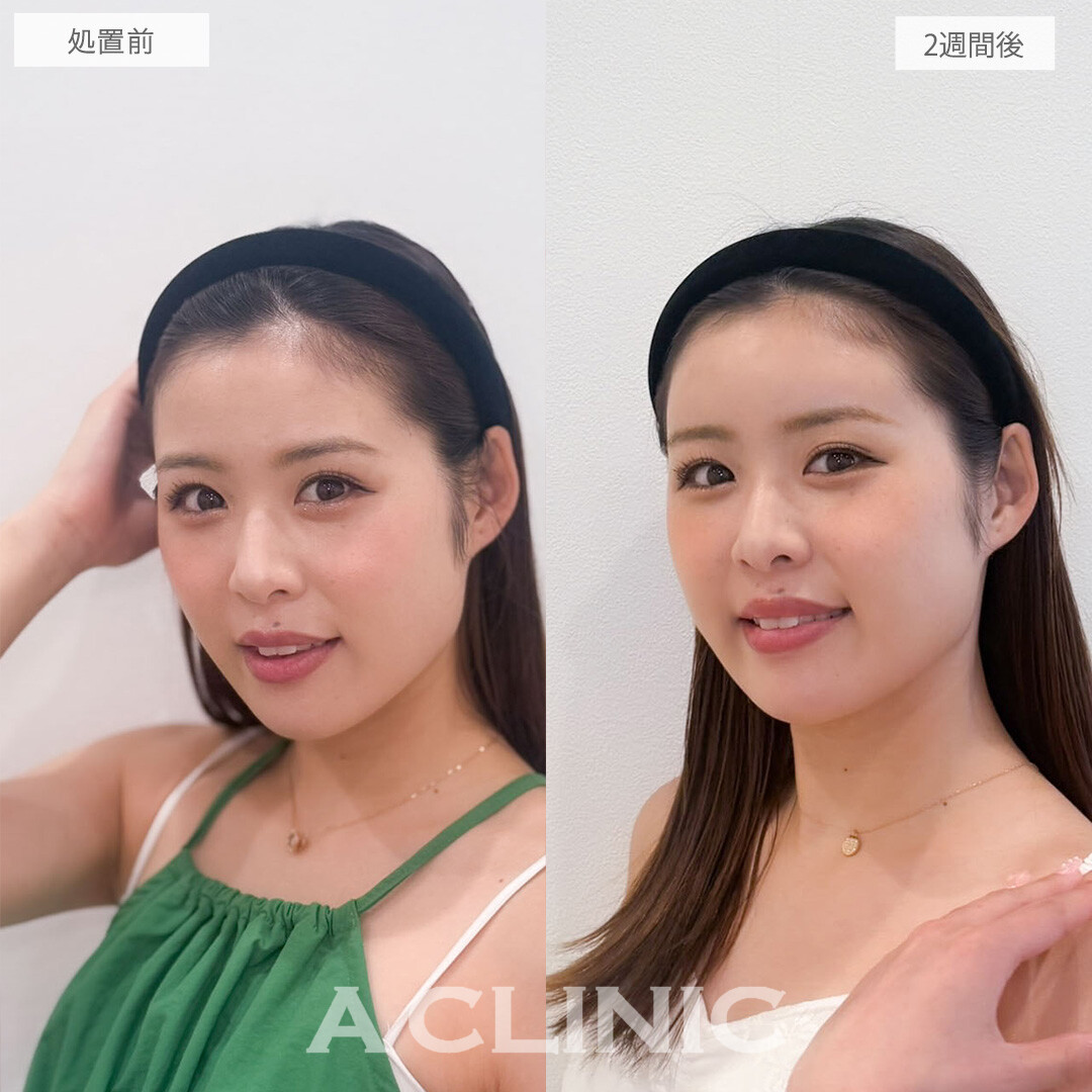 ヒアルロン酸カスタマイズメニューは2週間経過でこんなにナチュラルな仕上がりになります！こちら処置前と2週間後の症例です(20代女性)