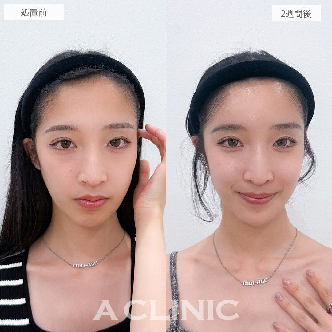 ヒアルロン酸カスタマイズメニューは注入だけで顔の立体感を作れます！こちら処置前と2週間後の症例です(20代女性)