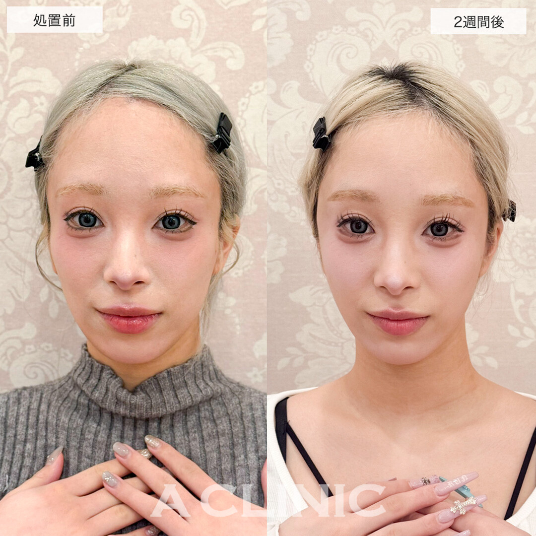 ヒアルロン酸カスタマイズメニューでコケ感が解消し一気に垢抜け!こちら処置前と2週間後の症例です(20代女性)
