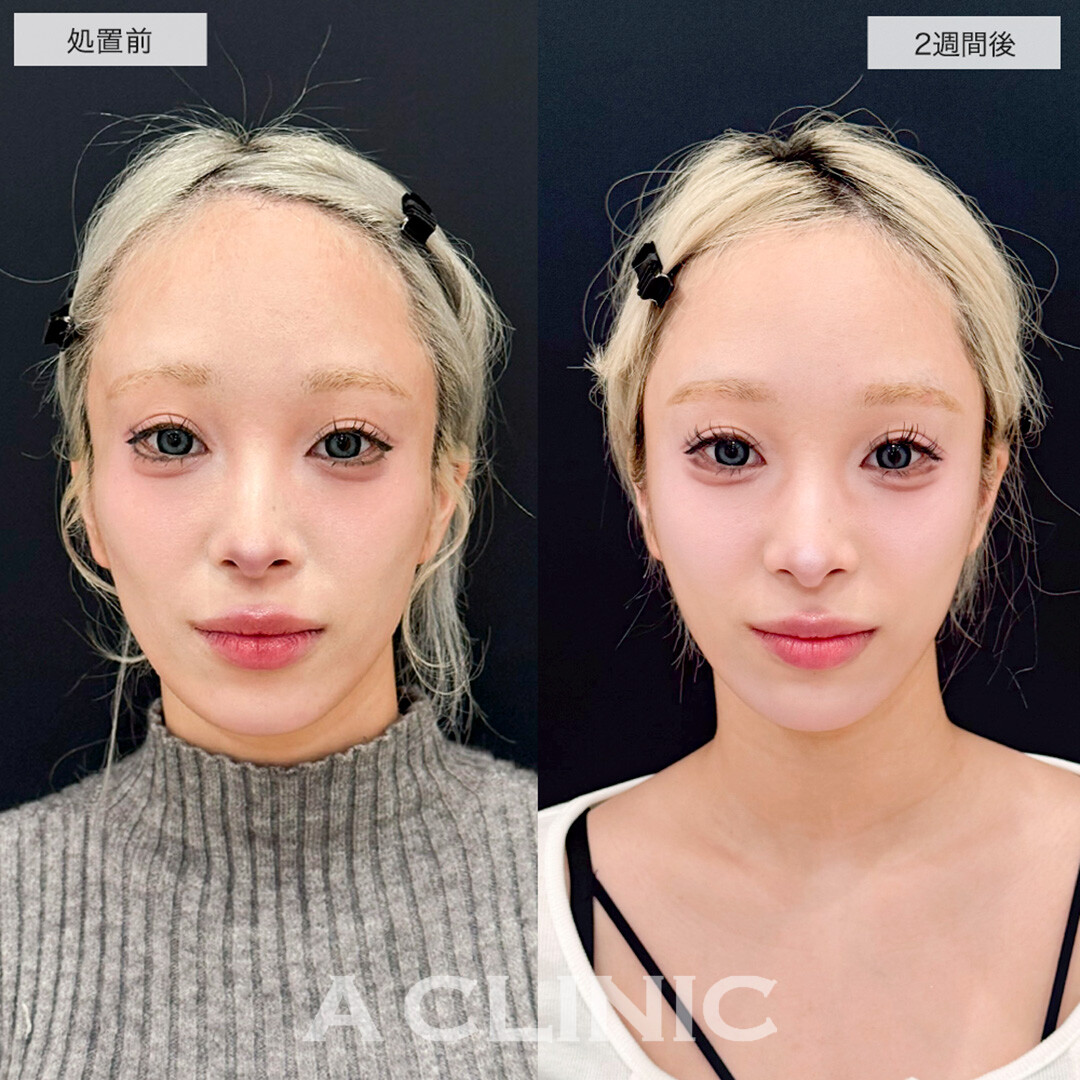 ヒアルロン酸カスタマイズメニューでコケ感が解消し一気に垢抜け!こちら処置前と2週間後の症例です(20代女性)
