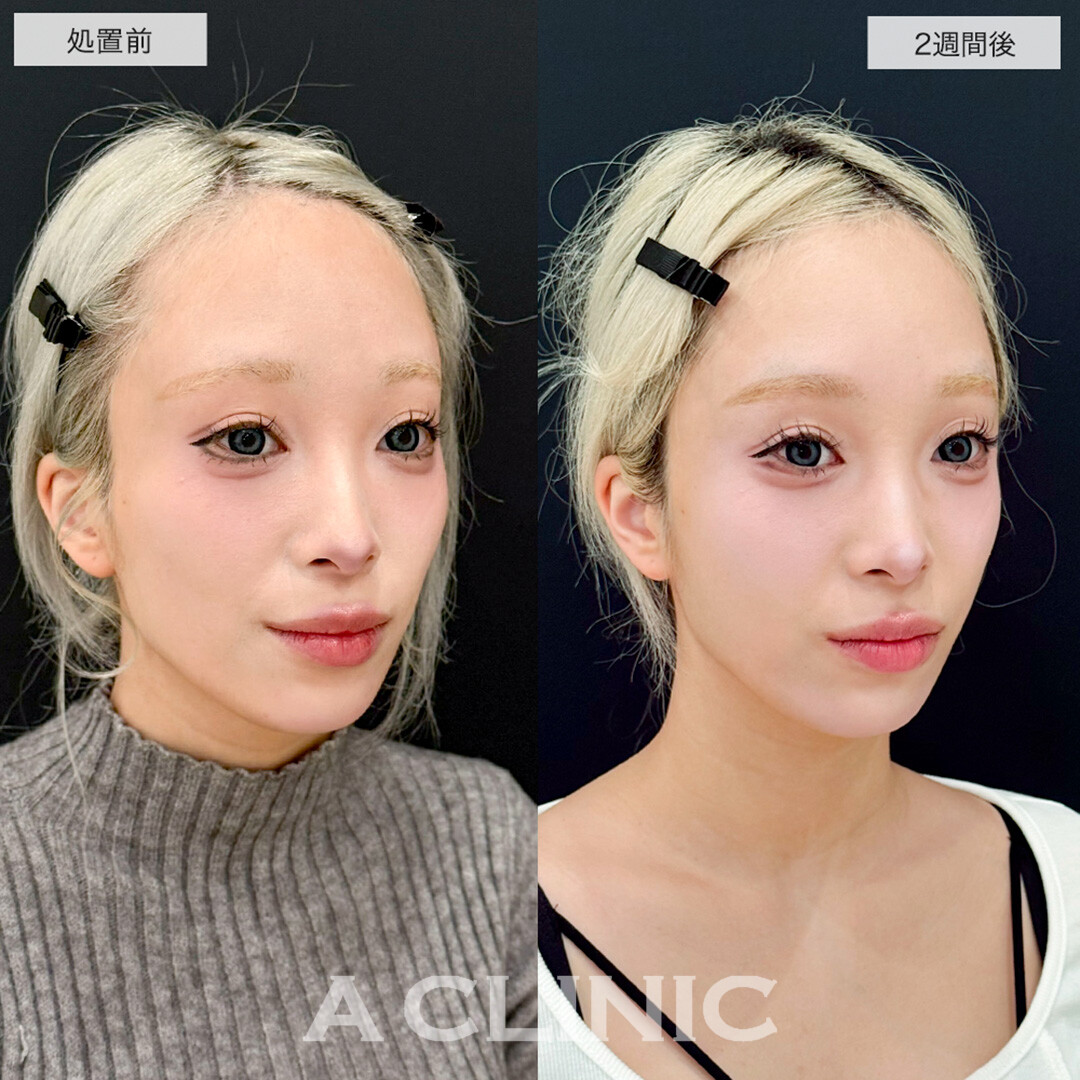 ヒアルロン酸カスタマイズメニューでコケ感が解消し一気に垢抜け!こちら処置前と2週間後の症例です(20代女性)
