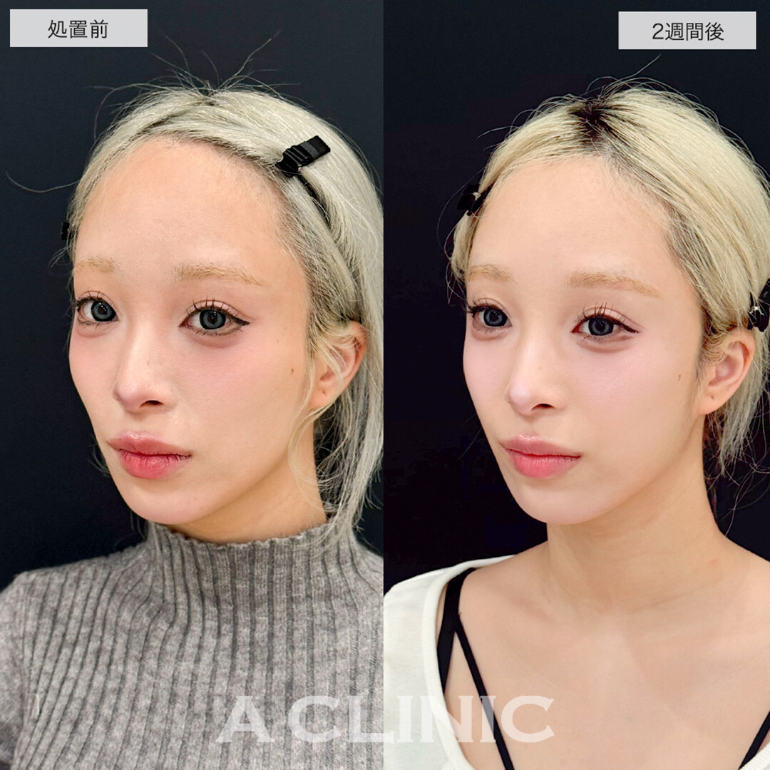 ヒアルロン酸カスタマイズメニューでコケ感が解消し一気に垢抜け!こちら処置前と2週間後の症例です(20代女性)