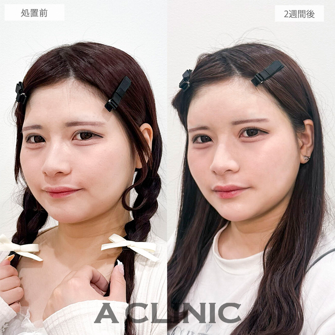 ヒアルロン酸カスタマイズメニューで輪郭のバランスが整いました！こちら処置前と2週間後の症例です(20代女性)