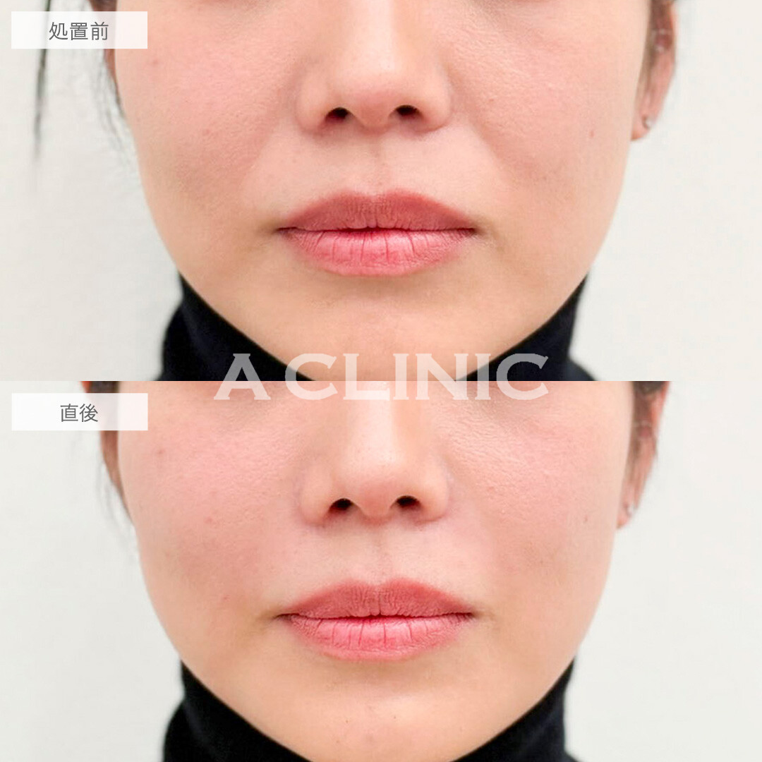 ヒアルロン酸注射(シワ)で即日若見えが叶う！処置前と直後の症例です(30代女性)