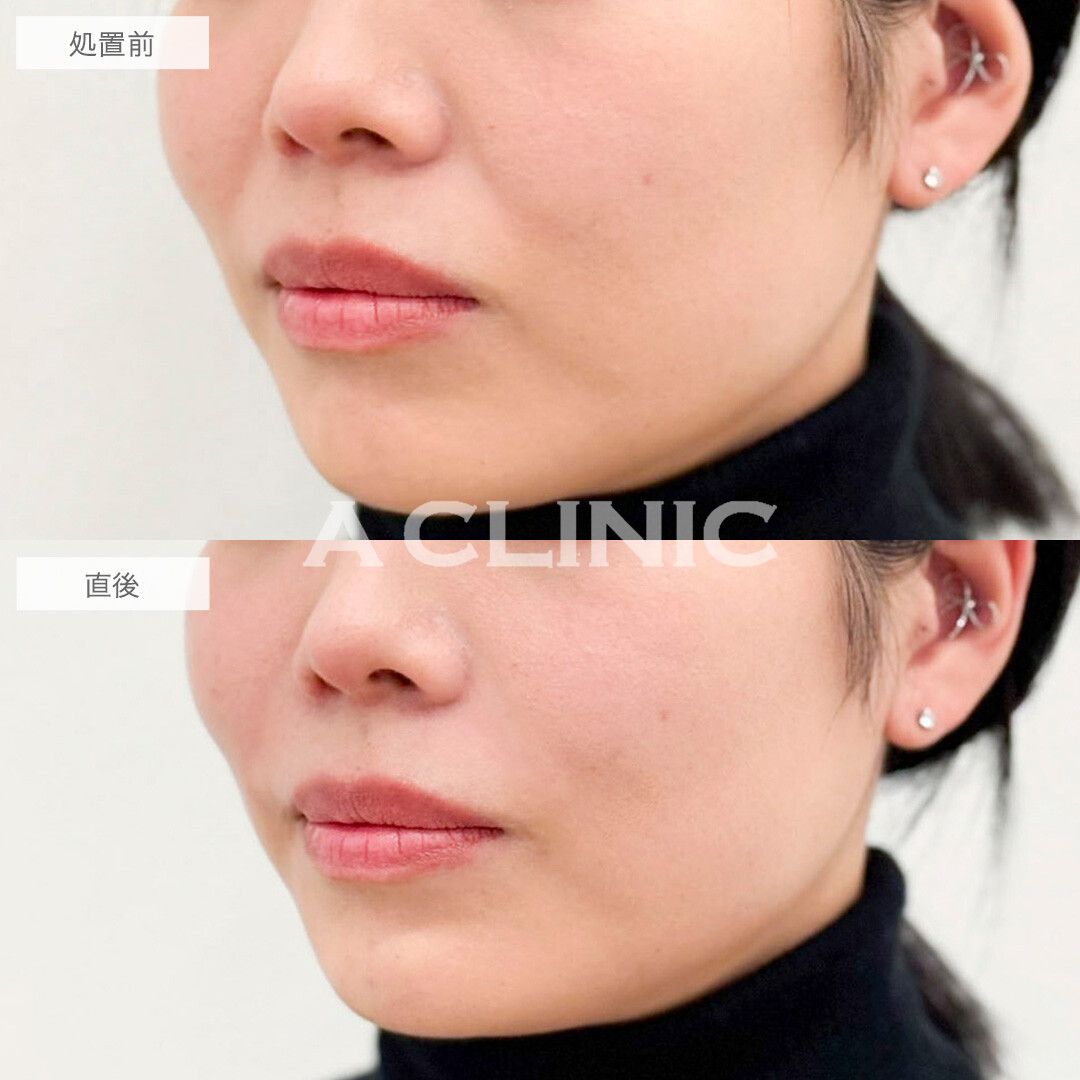 ヒアルロン酸注射(シワ)で即日若見えが叶う！処置前と直後の症例です(30代女性)