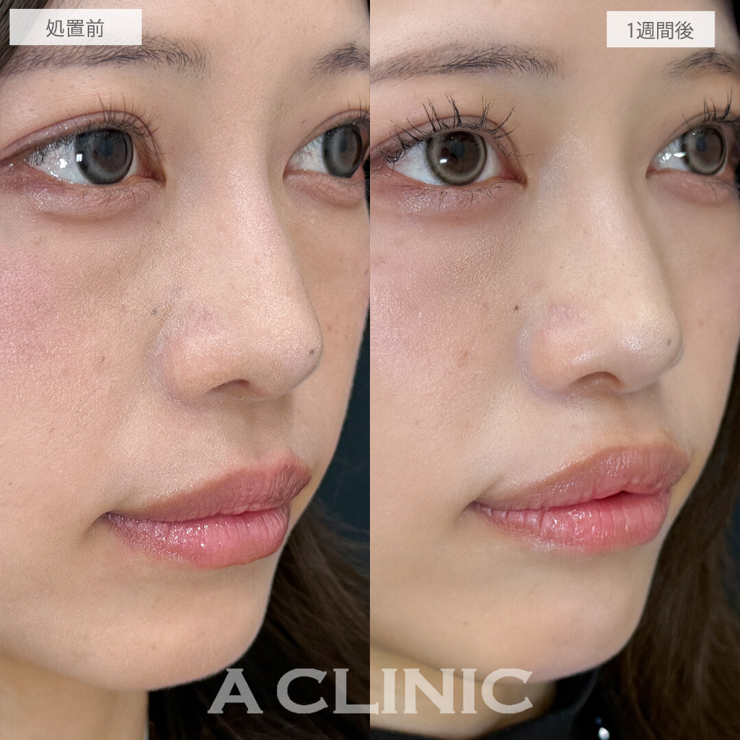 オーバーリップ不要のキュッと短い人中に！切らない人中短縮(Cカール形成術)の処置前と1週間後の症例です(20代女性)