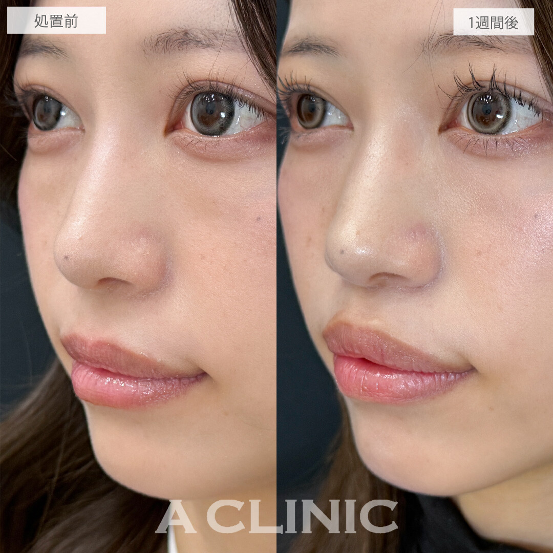 オーバーリップ不要のキュッと短い人中に！切らない人中短縮(Cカール形成術)の処置前と1週間後の症例です(20代女性)