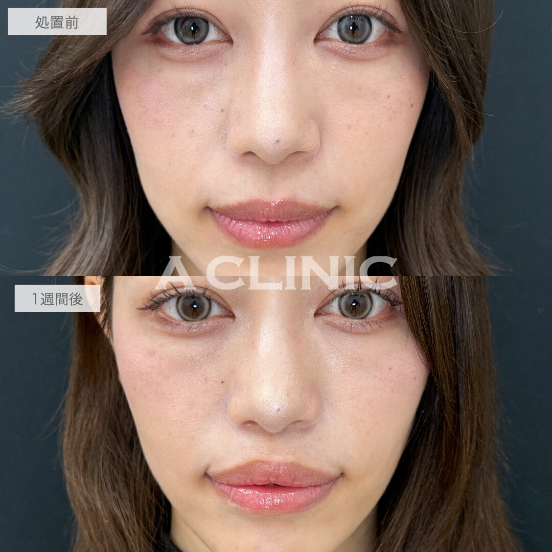 オーバーリップ不要のキュッと短い人中に！切らない人中短縮(Cカール形成術)の処置前と1週間後の症例です(20代女性)