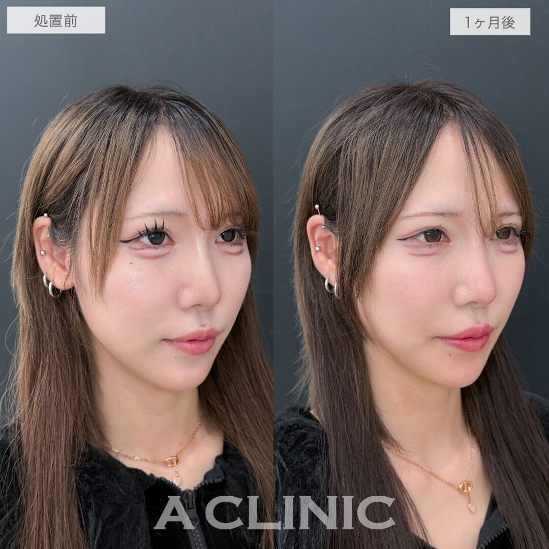 1day小顔脂肪吸引でフェイスラインもたつきがなくなり綺麗なVフェイスが誕生！処置前と1ヶ月後の症例です(20代女性)