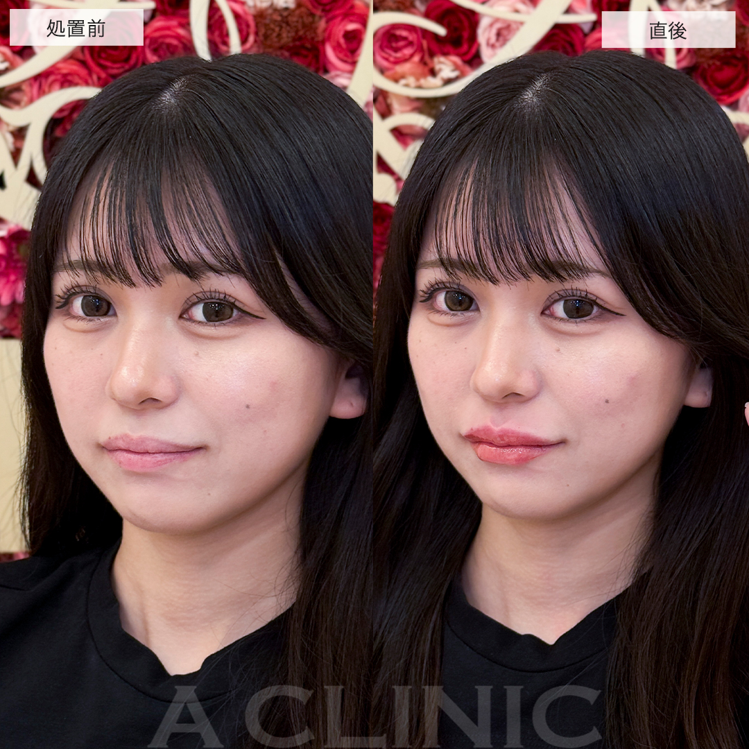 スマイルリップで立体感のあるぷっくり可愛い唇に！処置前と直後の症例です(20代女性)