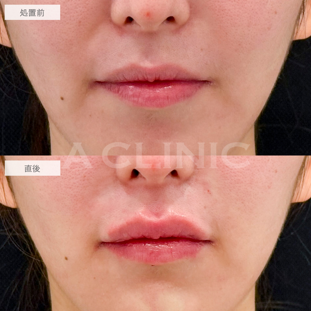 リップヒアルロン酸注入でどこから見ても立体感のある可愛らしい唇に！処置前と直後の症例です(20代女性)
