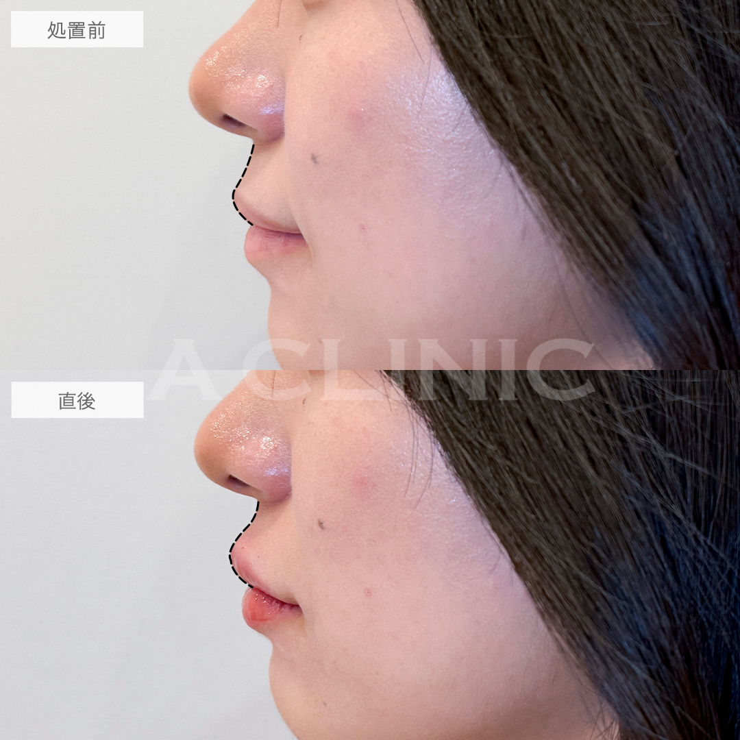 スマイルリップで立体感のあるぷっくり可愛い唇に！処置前と直後の症例です(20代女性)