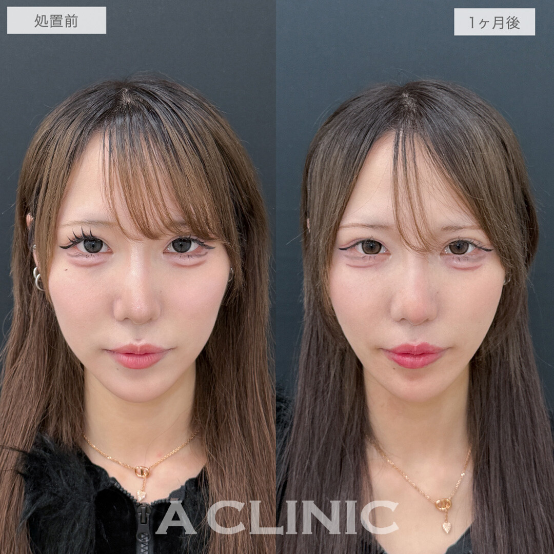 1day小顔脂肪吸引でフェイスラインもたつきがなくなり綺麗なVフェイスが誕生！処置前と1ヶ月後の症例です(20代女性)