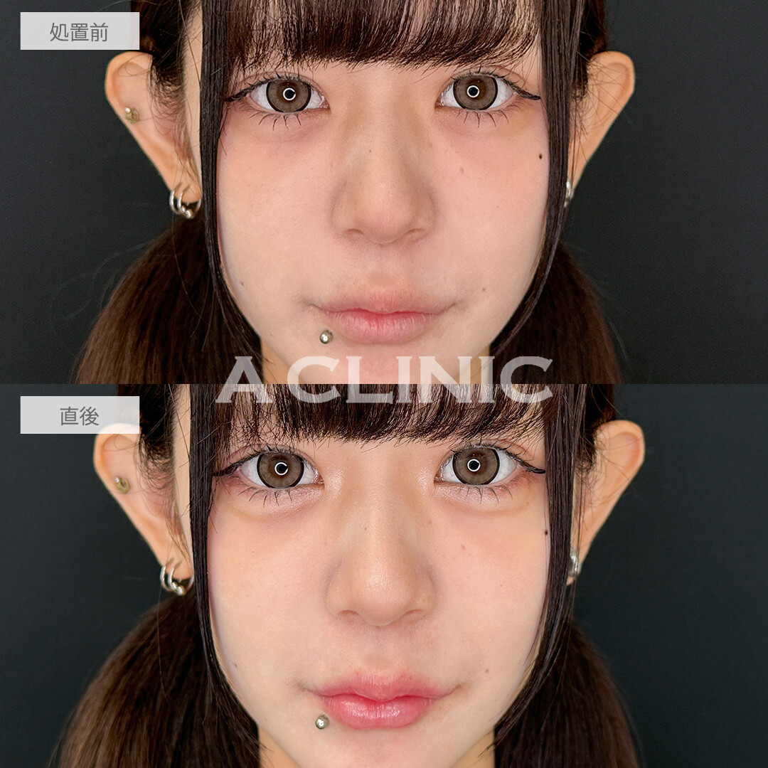 ヒアルロン酸注入だけで施術直後から中顔面を短縮できます！涙袋形成術(ヒアルロン酸)とリップヒアルロン酸注入の処置前と直後の症例です(20代女性)