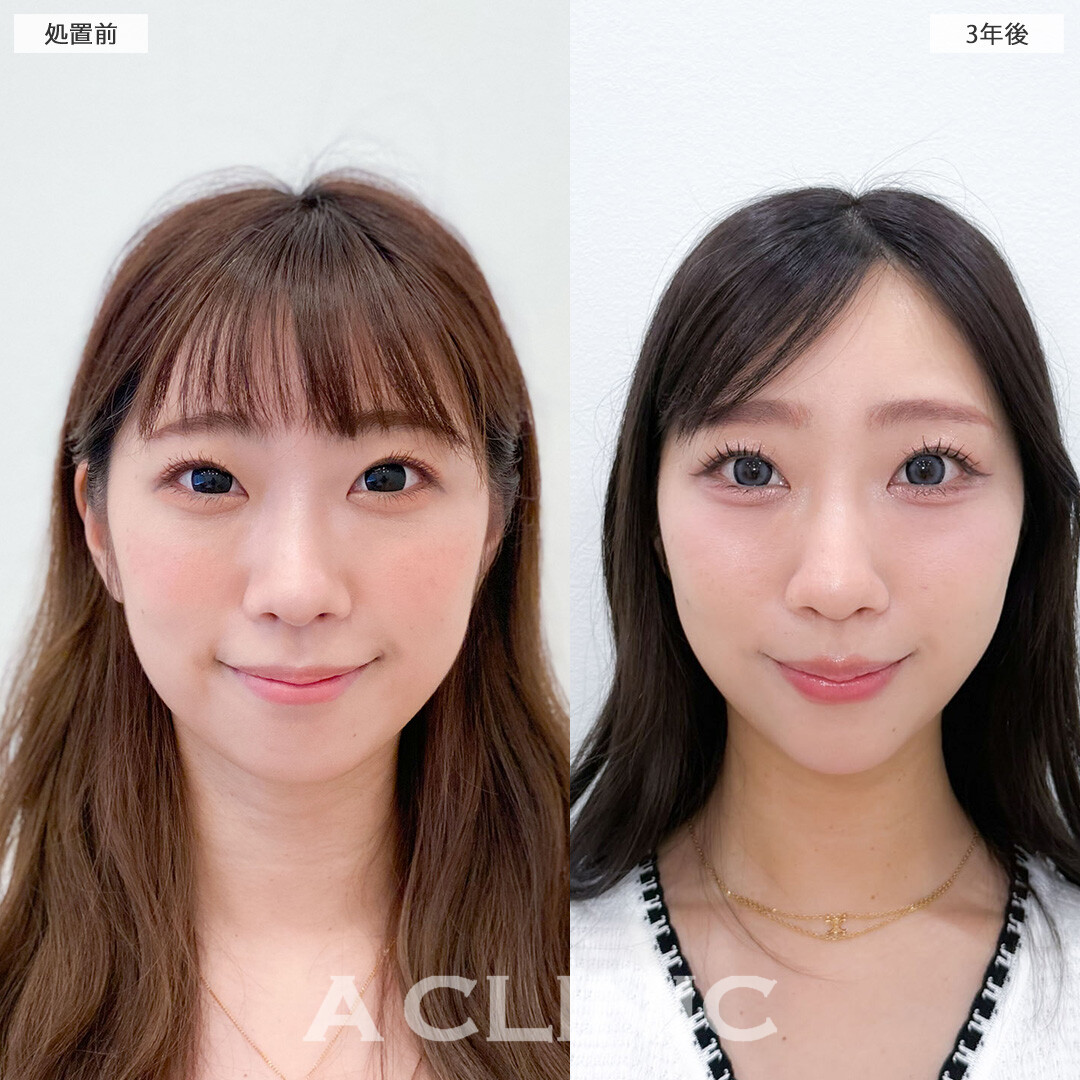 1day小顔脂肪吸引は3年たっても効果持続！こちら処置前と3年後の症例です(20代女性)