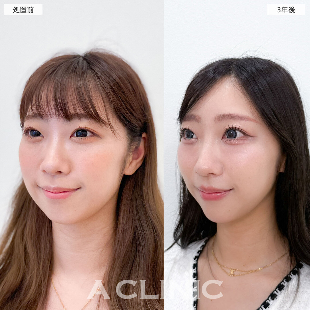 1day小顔脂肪吸引は3年たっても効果持続！こちら処置前と3年後の症例です(20代女性)