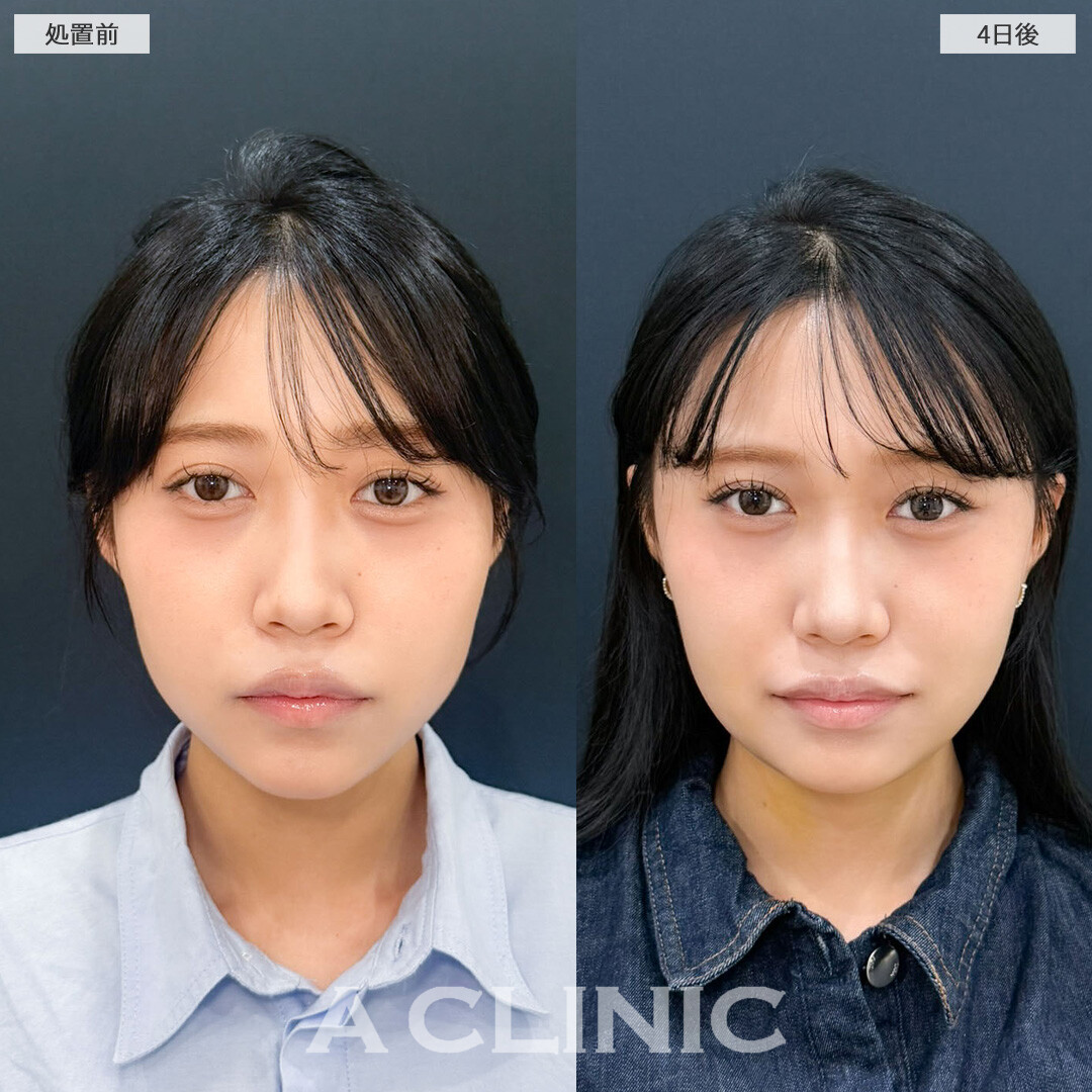 1day小顔脂肪吸引はダウンタイム少なく4日後でも効果を実感できる施術です！こちら処置前と4日後の症例です(20代女性)