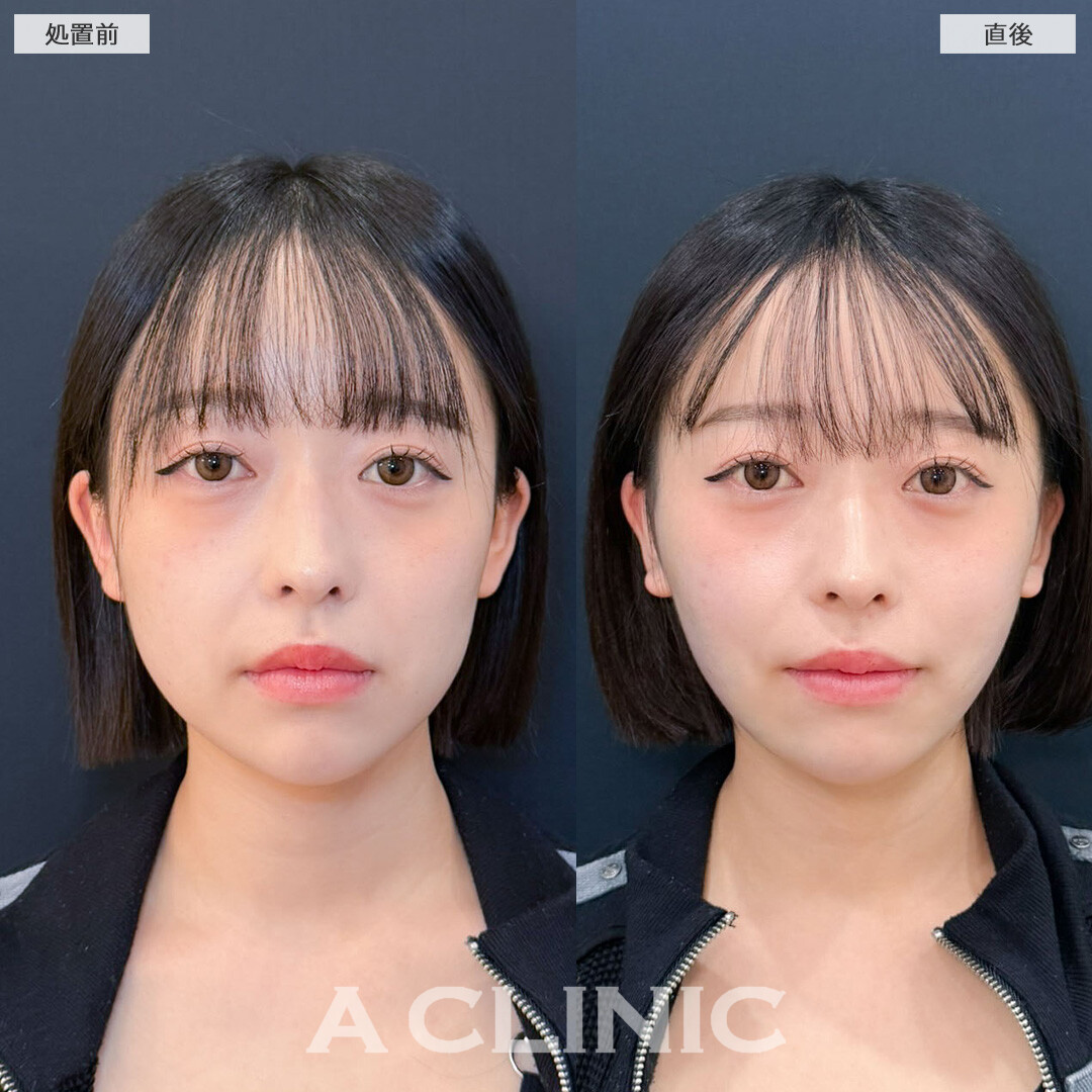 1day小顔脂肪吸引でしっかりVフェイスに可愛く変身！こちら処置前と直後の症例です(20代女性)
