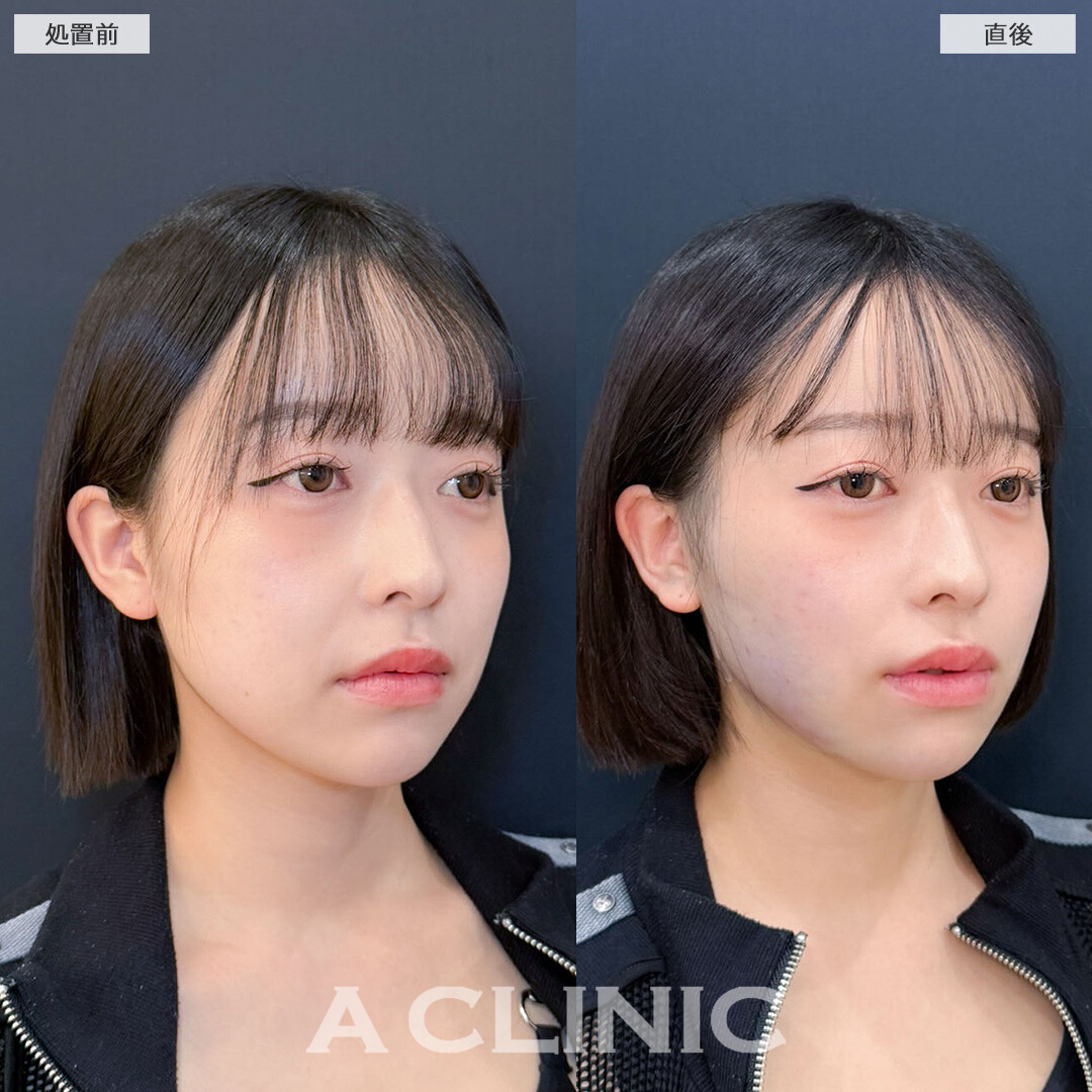 1day小顔脂肪吸引でしっかりVフェイスに可愛く変身！こちら処置前と直後の症例です(20代女性)