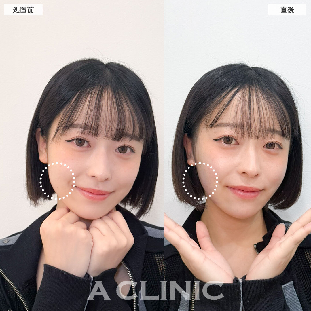 1day小顔脂肪吸引でしっかりVフェイスに可愛く変身！こちら処置前と直後の症例です(20代女性)