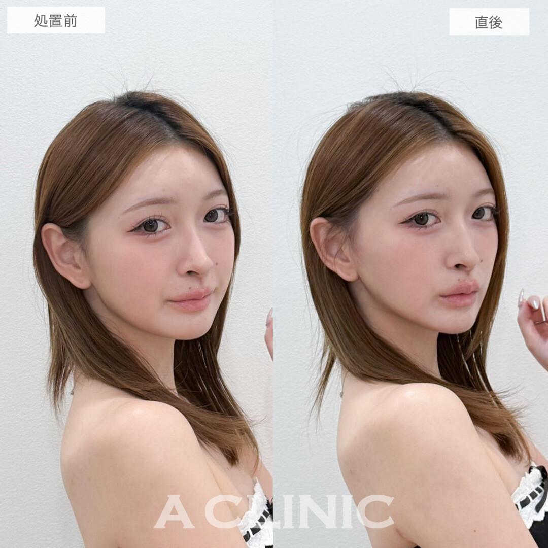 Aスレッドで左右差ともたつきが改善され綺麗なVラインが誕生！処置前と直後の症例です(20代女性)