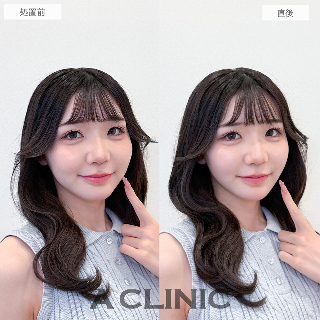 Aスレッドでフェイスラインのたるみが解消され理想のVフェイスに！処置前と直後の症例です(20代女性)