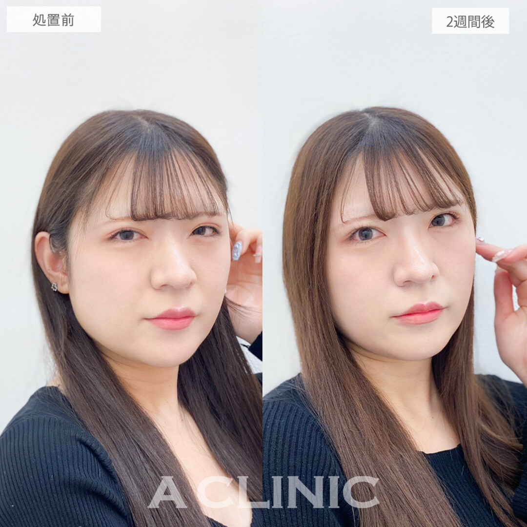 パーフェクトアイズで目元がひと回り大きく可愛らしい印象になりました！処置前と2週間後の症例です(20代女性)