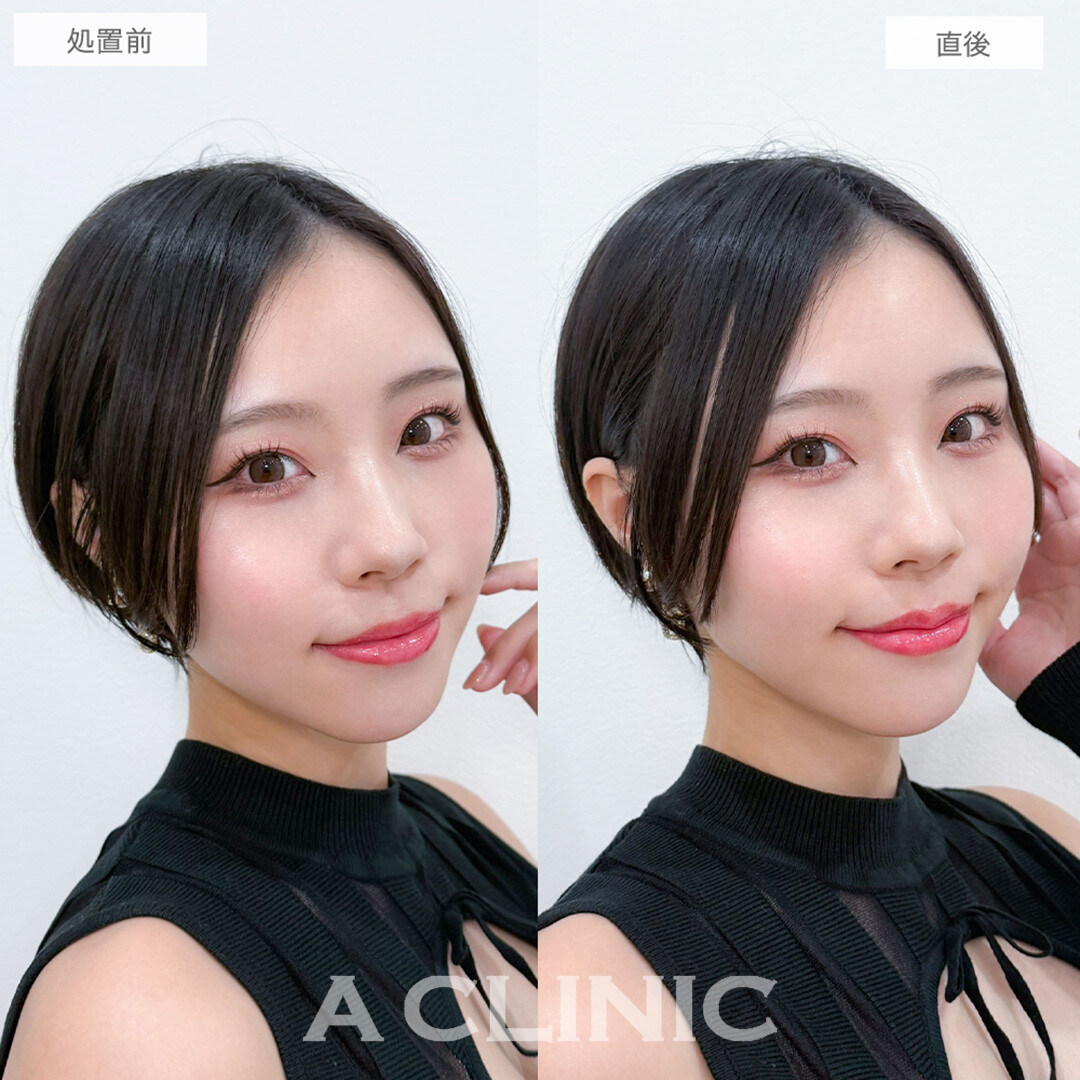 スマイルリップで自然に唇のボリュームアップが可能に！処置前と直後の症例です(30代女性)