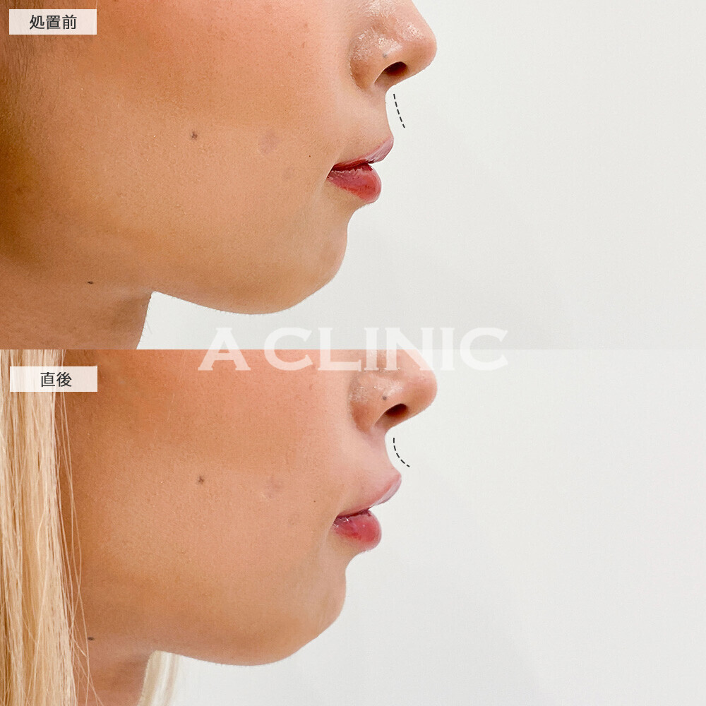 スマイルリップで上唇にボリュームが出て形も整いました！こちら処置前と直後の症例です。(20代女性)