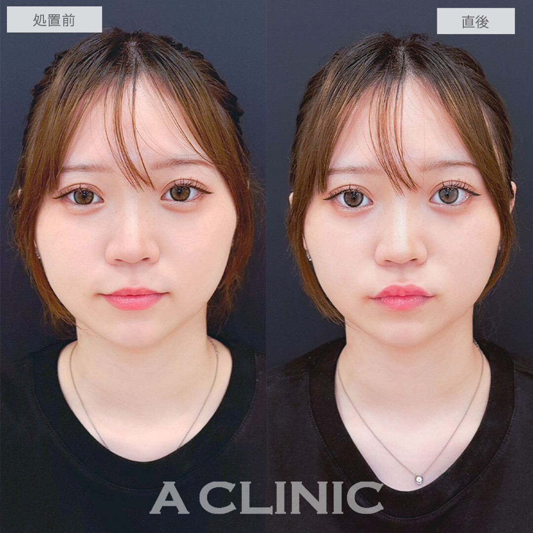 スマイルリップで自分好みな理想の唇で可愛さアップ！こちら処置前と直後の症例です(20代女性)