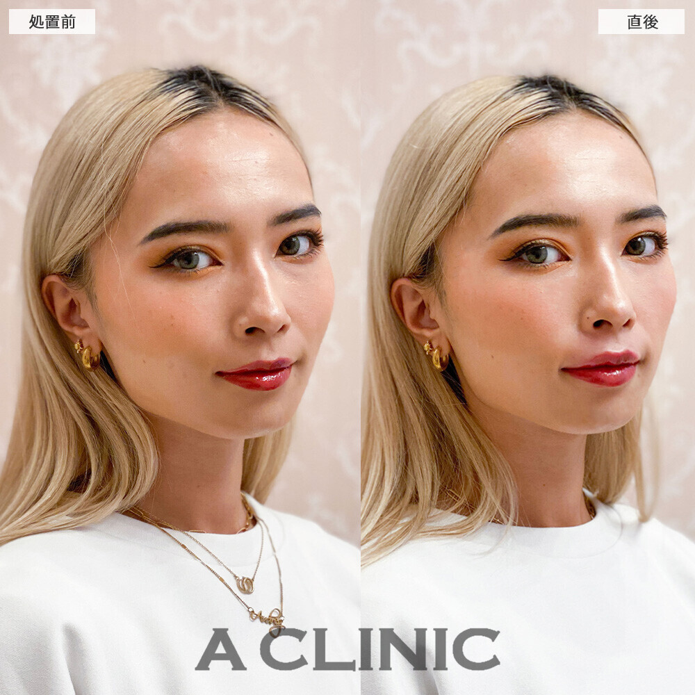 スマイルリップで上唇にボリュームが出て形も整いました！こちら処置前と直後の症例です。(20代女性)