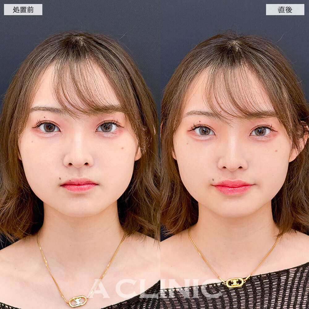 スマイルリップでお顔の余白も減って可愛い印象に！こちら処置前と直後の症例です。(20代女性)