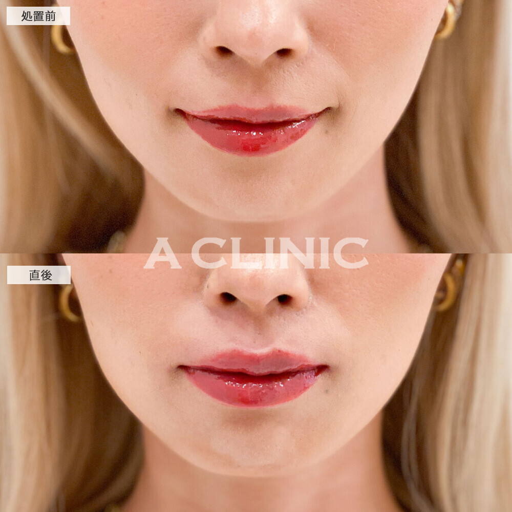 スマイルリップで上唇にボリュームが出て形も整いました！こちら処置前と直後の症例です。(20代女性)