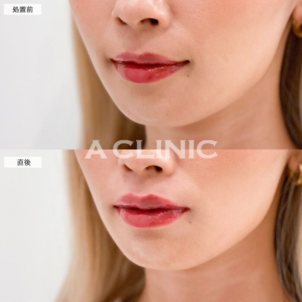 スマイルリップで上唇にボリュームが出て形も整いました！こちら処置前と直後の症例です。(20代女性)