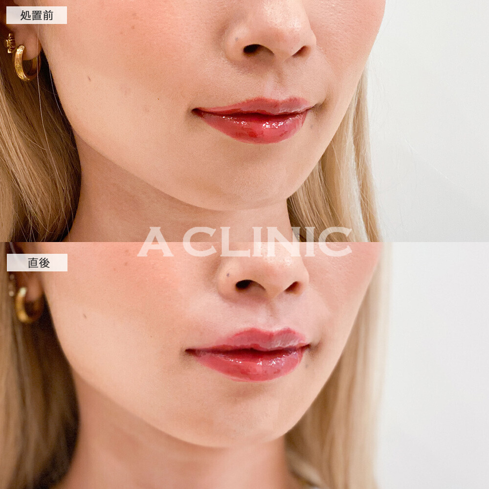 スマイルリップで上唇にボリュームが出て形も整いました！こちら処置前と直後の症例です。(20代女性)