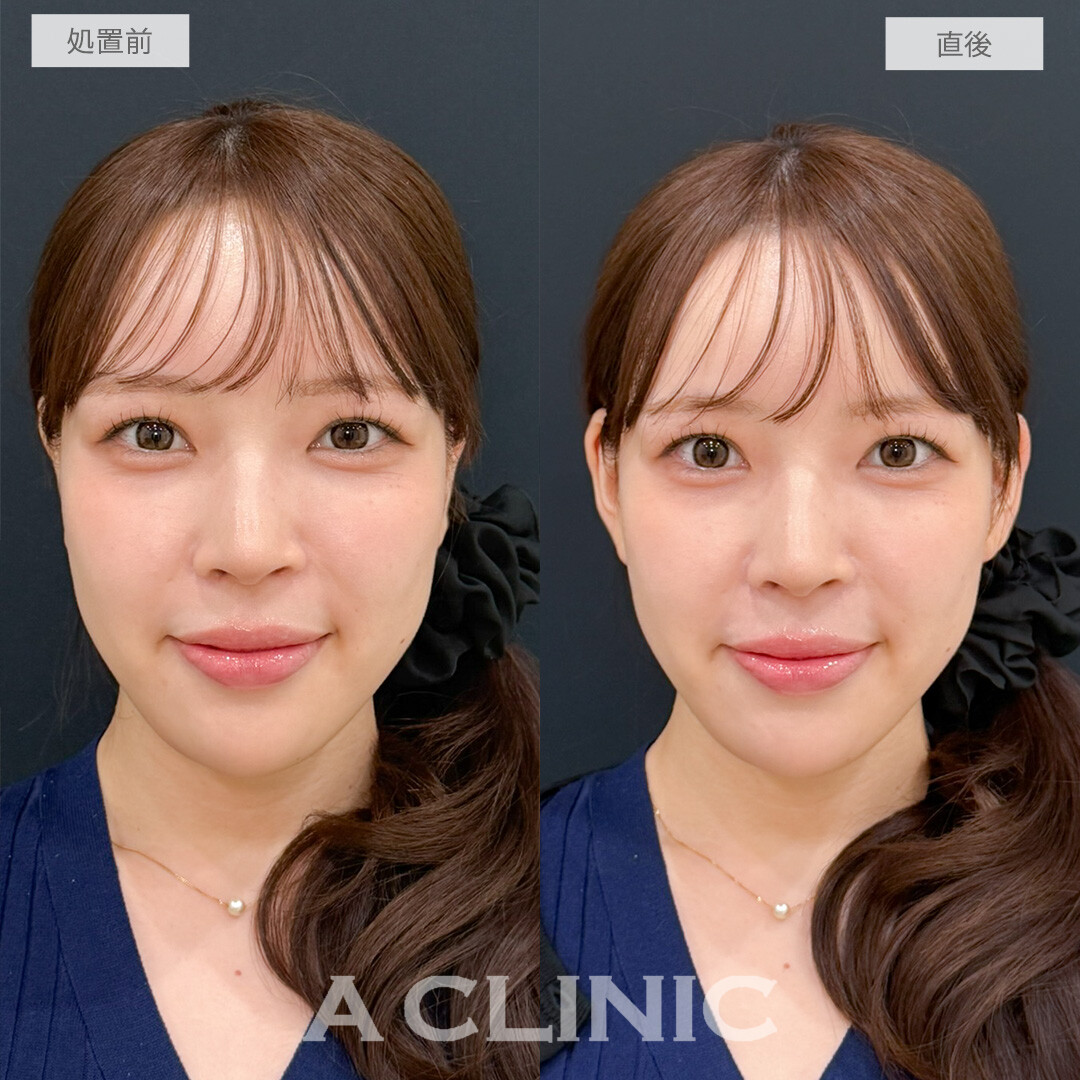 立ち耳ヒアルロン酸注入(ボリューマ)で面長が目立たなくなりより女性らしい可愛いお顔になりました！処置前と直後の症例です(20代女性)