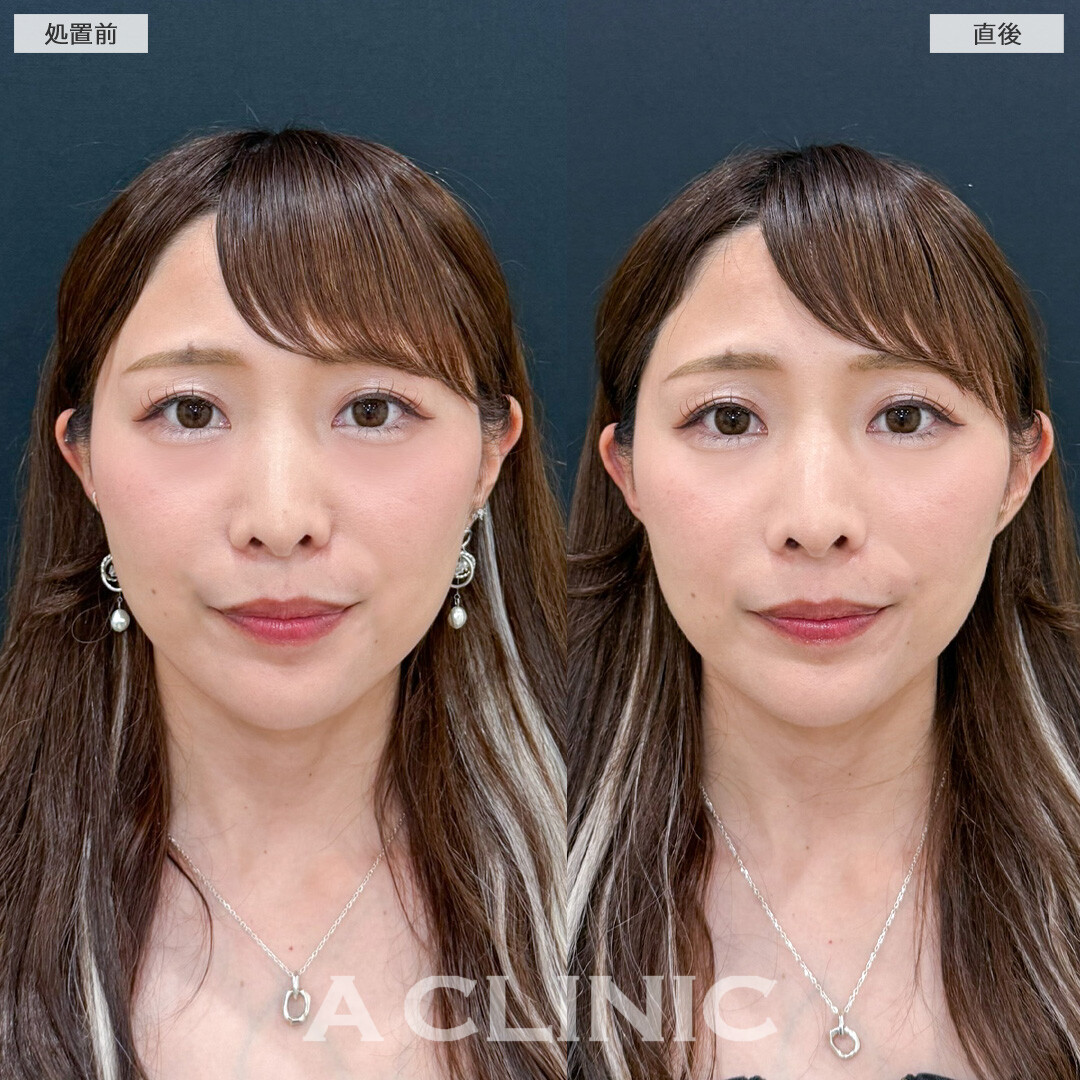 立ち耳ヒアルロン酸注入(ボリューマ)で中顔面短縮効果を絶大発揮しちゃいました！こちら処置前と直後の症例です。(30代女性)