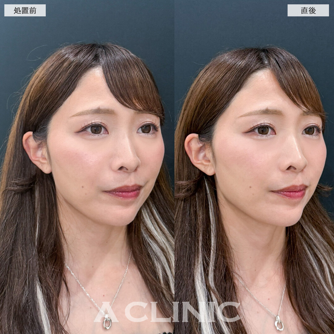 立ち耳ヒアルロン酸注入(ボリューマ)で中顔面短縮効果を絶大発揮しちゃいました！こちら処置前と直後の症例です。(30代女性)