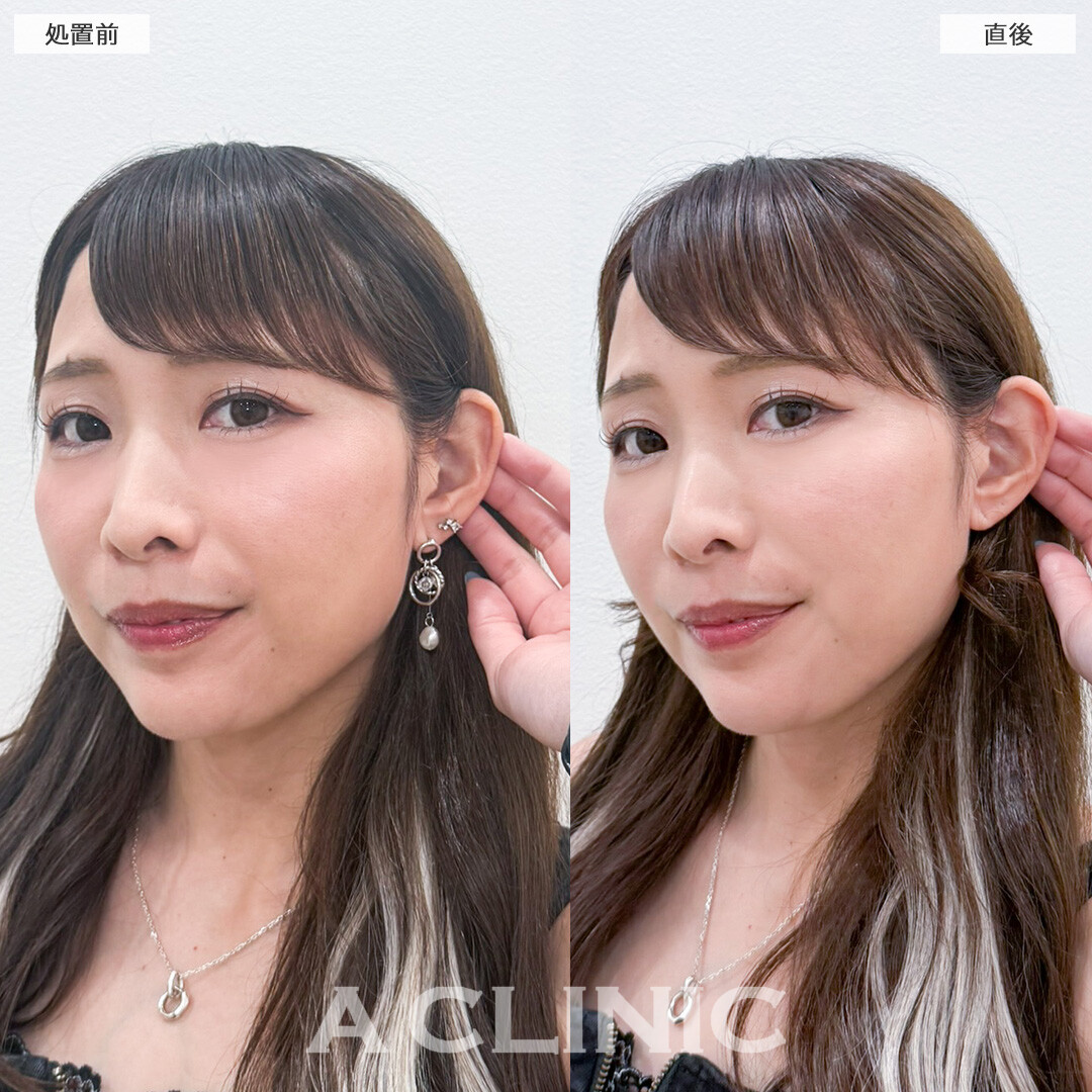 立ち耳ヒアルロン酸注入(ボリューマ)で中顔面短縮効果を絶大発揮しちゃいました！こちら処置前と直後の症例です。(30代女性)
