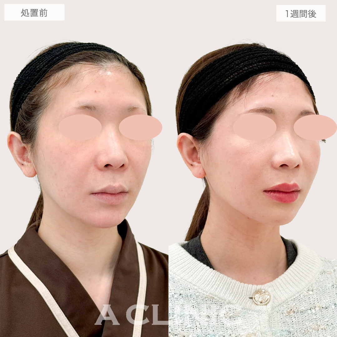 A式美肌たるみ切開で顔の重心が上がり劇的に若返り！処置前と1週間後の症例です(30代女性)
